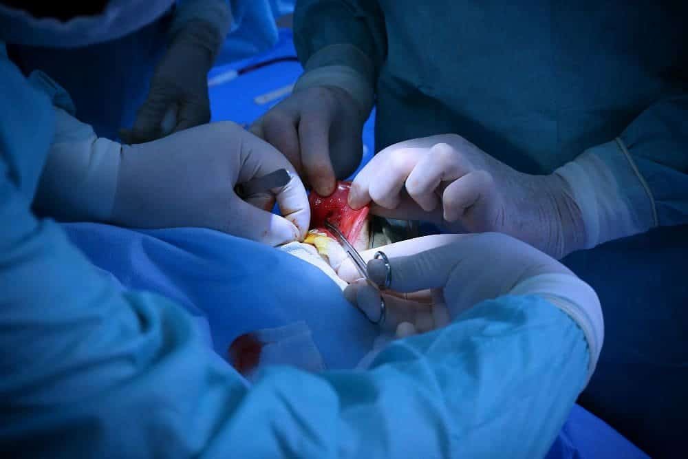 Varicocele Embolization vs Surgery