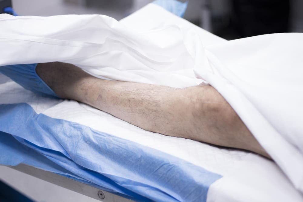 Varicocele Embolisation